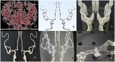 Frictional force analysis of stent retriever devices using a realistic vascular model: Pilot study